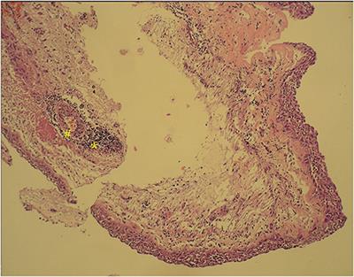 Intraventricular Craniopharyngiomas—Overcoming Their Relative Inaccessibility: Institutional Experience With a Review of Literature